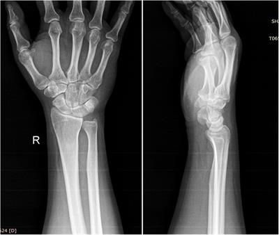 Carpal tunnel syndrome caused by tophi in the superficial flexor tendon: a case report